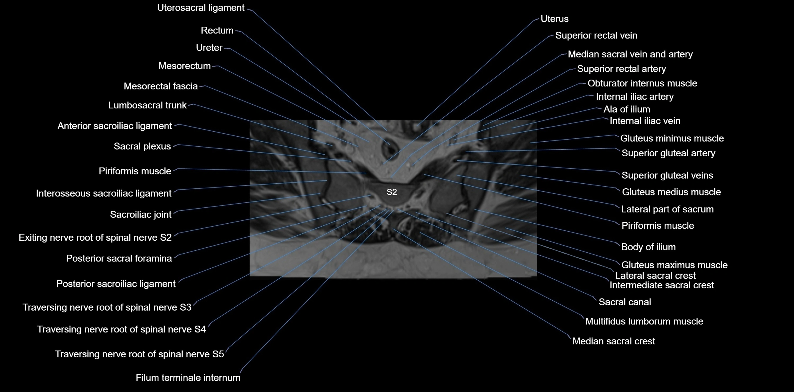 MRI sacrum, coccyx and sacroiliac joint axial cross sectional anatomy 3T  radiology  image-img-00001-00031.webp